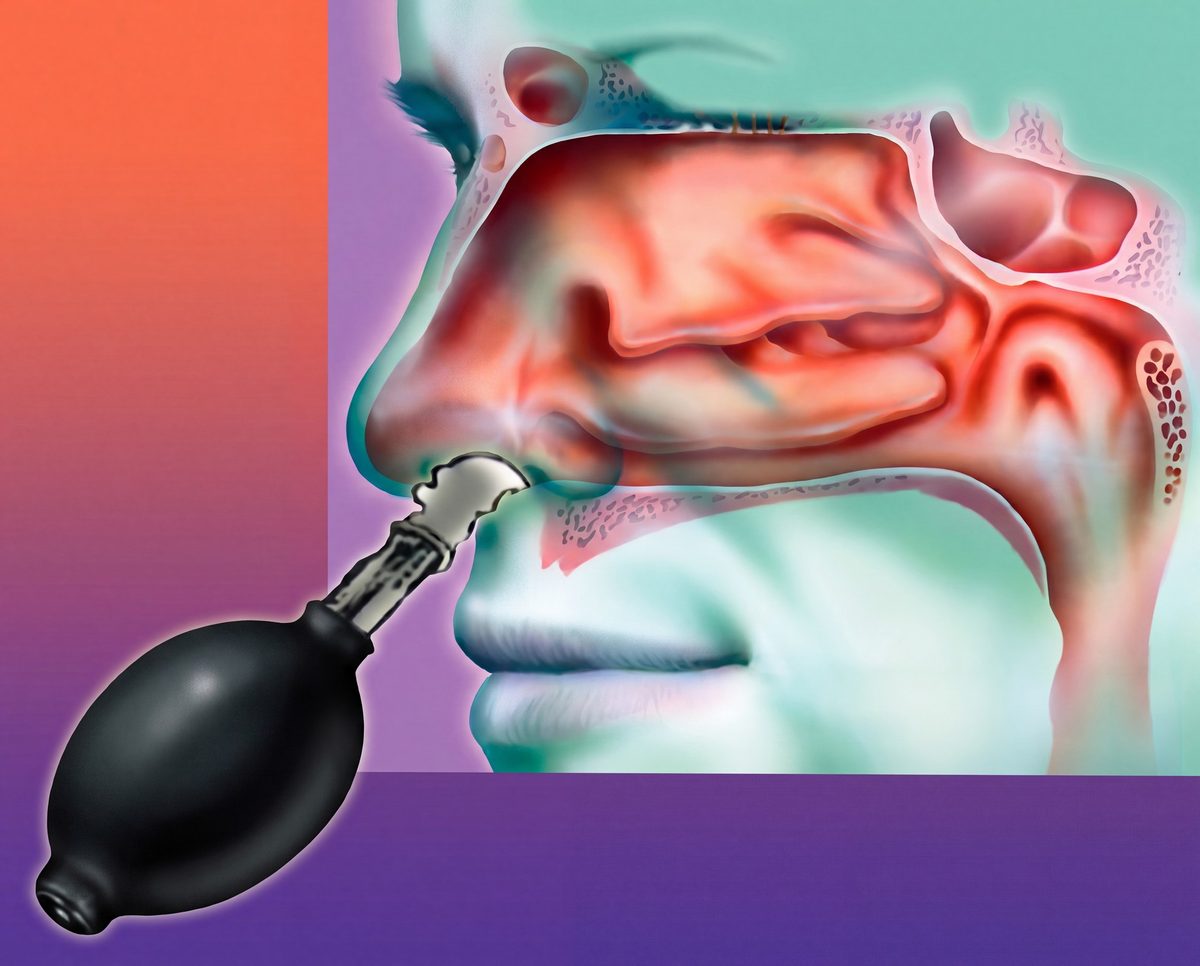 Cross-section illustration of the nasal passage with the Cranial Facial Release balloon inflation device in position