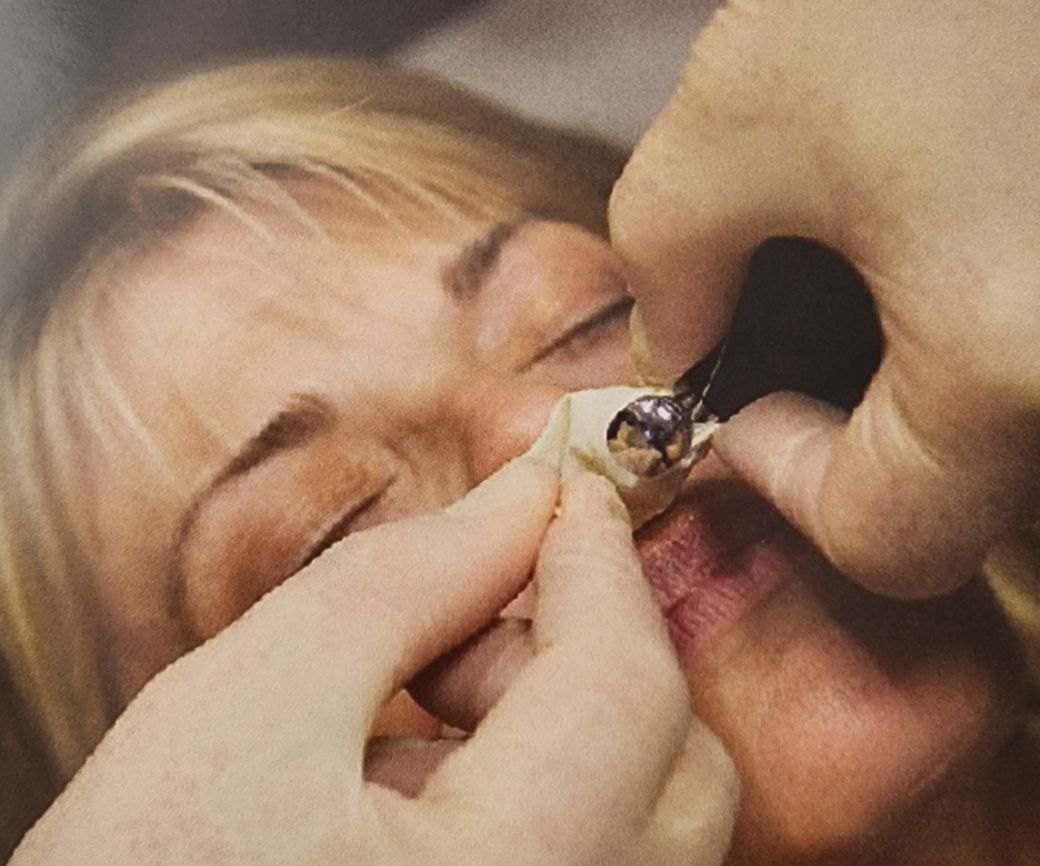 A patient receiving Cranial Facial Release, the endonasal balloon at her nose